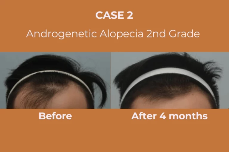 ExoHair Case 2