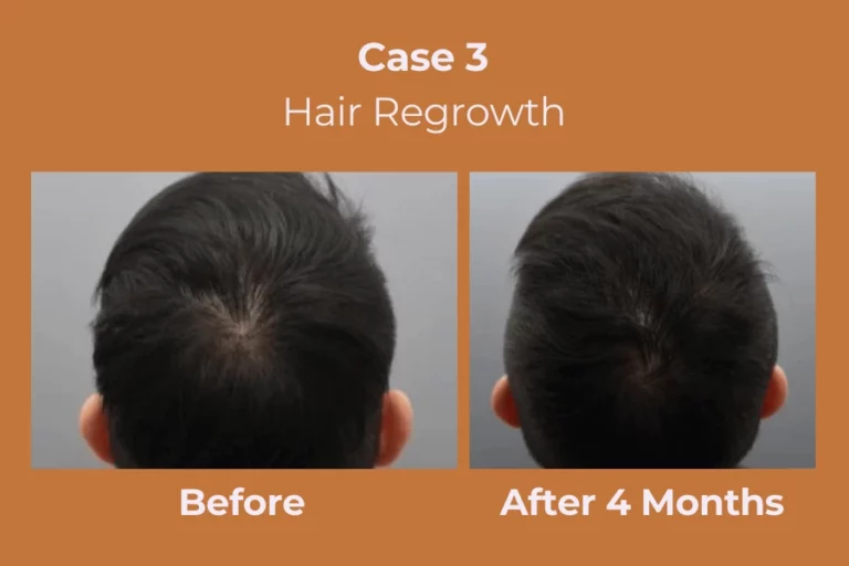 ExoHair Case 3
