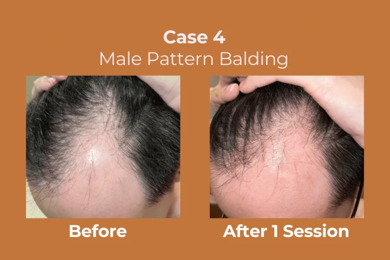 ExoHair Case 4