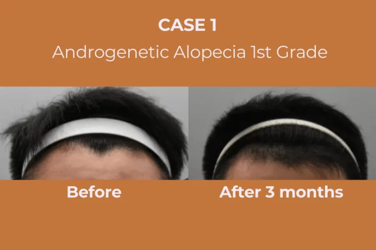ExoHair Case 1